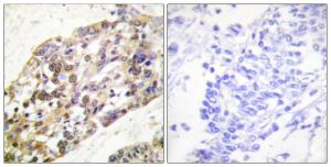 Immunohistochemical analysis of paraffin-embedded human breast carcinoma tissue using Anti-Histone H3 Antibody. The right hand panel represents a negative control, where the antibody was pre-incubated with the immunising peptide