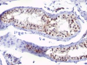 Immunohistochemical analysis of formalin-fixed, paraffin-embedded human testicular carcinoma using Anti-Thymidylate Synthase Antibody [SPM453]