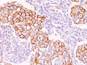 Immunohistochemical analysis of formalin-fixed, paraffin-embedded human breast carcinoma using Anti-Phosphotyrosine Antibody [PY20]