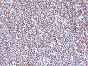 Immunohistochemical analysis of formalin-fixed, paraffin-embedded human anaplastic large cell lymphoma using Anti-ALK Antibody [ALK/1504]