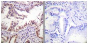 Immunohistochemical analysis of paraffin-embedded human lung carcinoma tissue using Anti-Histone H3 Antibody. The right hand panel represents a negative control, where the antibody was pre-incubated with the immunising peptide