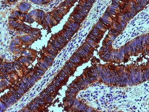 Immunohistochemistry staining of human colon adenocarcinoma (paraffin sections) using Anti-Blood Group Lewis b Antibody (A85997)