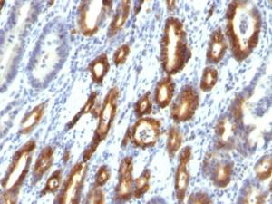 Immunohistochemical analysis of formalin-fixed, paraffin-embedded human gastric carcinoma using Anti-MUC6 Antibody [MUC6/916]