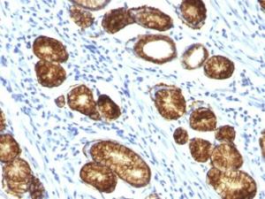 Immunohistochemical analysis of formalin-fixed, paraffin-embedded human gastric carcinoma using Anti-MUC6 Antibody [MUC6/916]