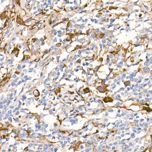 Immunohistochemistry analysis of paraffin-embedded human Hodgkin lymphoma (positive control antibody staining, clone 55k-2) using Anti-Fascin Antibody [ARC1638] (A306042) at a dilution of 1:100 (40x lens)