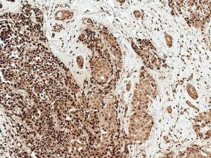 Immunohistochemistry analysis of human breast cancer, fixed in formalin and paraffin-embedded