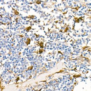 Immunohistochemistry analysis of paraffin-embedded human Hodgkin lymphoma using Anti-Fascin Antibody [ARC1638] (A306042) at a dilution of 1:100 (40x lens)