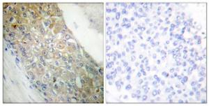 Immunohistochemical analysis of paraffin-embedded human breast carcinoma tissue using Anti-IR Antibody. The right hand panel represents a negative control, where the antibody was pre-incubated with the immunising peptide.