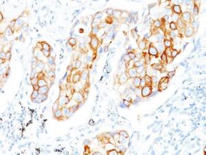 Immunohistochemical analysis of formalin-fixed, paraffin-embedded human lung squamous cell carcinoma using Anti-Cytokeratin 7 + 17 Antibody [C-46]