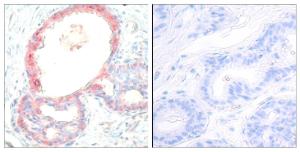 Immunohistochemical analysis of paraffin-embedded human breast carcinoma using Anti-Rel (phospho Ser503) Antibody The right hand panel represents a negative control, where the antibody was pre-incubated with the immunising peptide