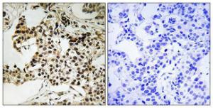 Immunohistochemical analysis of paraffin-embedded human breast carcinoma using Anti-PKR (phospho Thr258) Antibody The right hand panel represents a negative control, where the antibody was pre-incubated with the immunising peptide