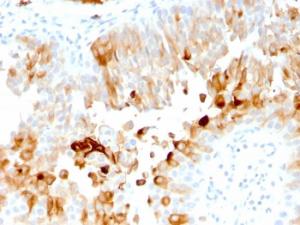 Immunohistochemical analysis of formalin-fixed, paraffin-embedded human urothelial carcinoma using Anti-Uroplakin 1A Antibody [UPK1A/2921]