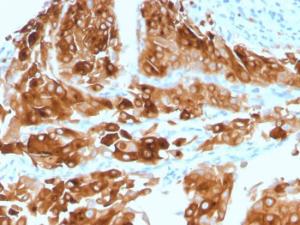 Immunohistochemical analysis of formalin-fixed, paraffin-embedded human urothelial carcinoma using Anti-Uroplakin 1A Antibody [UPK1A/2921]