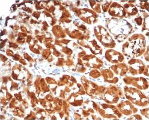 Immunohistochemical analysis of formalin-fixed, paraffin-embedded human colon carcinoma tissue using Anti-IL-2 Antibody [IL2/7051R]