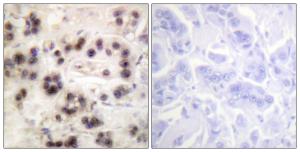 Immunohistochemical analysis of paraffin-embedded human breast carcinoma using Anti-p63 (phospho Ser455) Antibody The right hand panel represents a negative control, where the antibody was pre-incubated with the immunising peptide