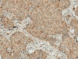 Immunohistochemistry analysis of human breast cancer, fixed in formalin and paraffin-embedded The Primary Antibody used was Anti-Smad4 Antibody (A304891) at 1:50 for 30 minutes at room temperature Counterstain: Hematoxylin Magnification: 10X HRP-DAB Detection