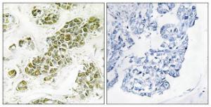 Immunohistochemical analysis of paraffin-embedded human breast carcinoma tissue using Anti-eIF2 alpha Antibody. The right hand panel represents a negative control, where the antibody was pre-incubated with the immunising peptide