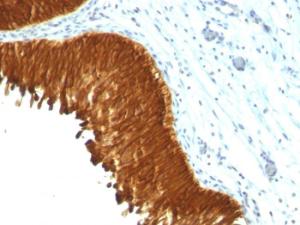 Immunohistochemical analysis of formalin-fixed, paraffin-embedded human bladder carcinoma using Anti-pan Cytokeratin Antibody [KRT/457]