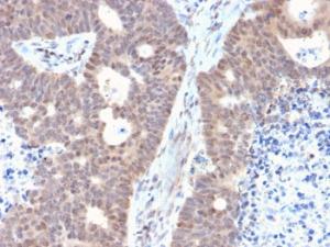 Immunohistochemical analysis of formalin-fixed, paraffin-embedded human colon carcinoma using Anti-FAF1 Antibody [CPTC-FAF1-2]