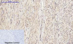 Immunohistochemical analysis of paraffin-embedded human uterus cancer tissue using Anti-eIF2 alpha Antibody at 1:200 (4°C overnight). Negative control was secondary antibody only