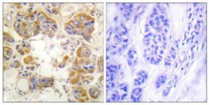 Immunohistochemical analysis of paraffin-embedded human breast carcinoma tissue using Anti-Collagen I Antibody. The right hand panel represents a negative control, where the antibody was pre-incubated with the immunising peptide.