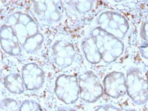 Immunohistochemical analysis of formalin-fixed, paraffin-embedded human colon carcinoma using Anti-DC-SIGN Antibody [rC209/1781]