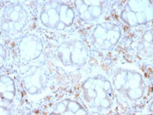 Immunohistochemical analysis of formalin-fixed, paraffin-embedded human colon carcinoma using Anti-DC-SIGN Antibody [rC209/1781]