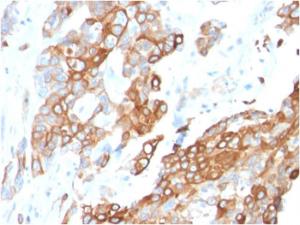 Immunohistochemical analysis of formalin-fixed, paraffin-embedded human breast carcinoma using Anti-Heregulin Antibody [NRG1/2710]