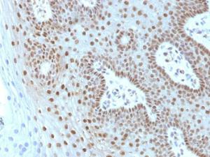 Immunohistochemical analysis of formalin-fixed, paraffin-embedded human cervical carcinoma using Anti-c-Myc Antibody [MYC275 + MYC909]