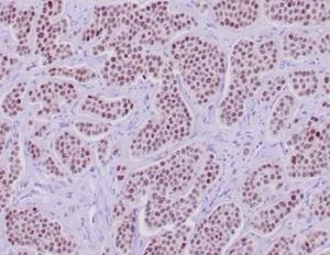 Immunohistochemical analysis of formalin-fixed, paraffin-embedded human neuroendocrine tumor tissue using Anti-INSM1 Antibody [INSM1/6286R]