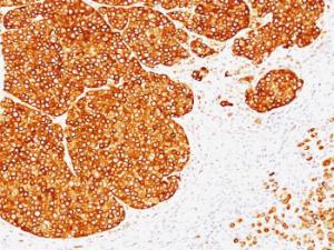 Immunohistochemical analysis of formalin-fixed, paraffin-embedded human melanoma using Anti-Tyrosinase Antibody [SPM360]