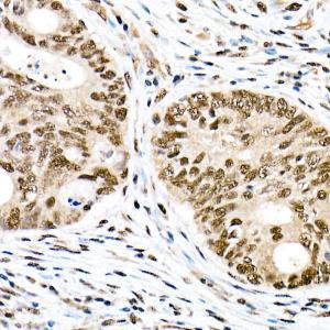 Immunohistochemistry analysis of paraffin-embedded human colon carcinoma tissue using Anti-FOXO1A (phospho Ser319) Antibody (A308977) at a dilution of 1:50 (40x lens)