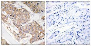 Immunohistochemical analysis of paraffin-embedded human breast carcinoma tissue using Anti-IL-13R Antibody. The right hand panel represents a negative control, where the antibody was pre-incubated with the immunising peptide.