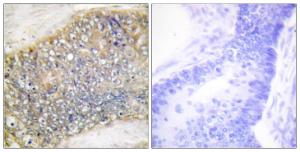 Immunohistochemical analysis of paraffin-embedded human colon carcinoma tissue using Anti-TALL-2 Antibody. The right hand panel represents a negative control, where the antibody was pre-incubated with the immunising peptide