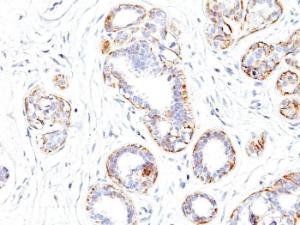 Immunohistochemical analysis of formalin-fixed, paraffin-embedded human breast carcinoma using Anti-MYH11 Antibody [SMMS-1]