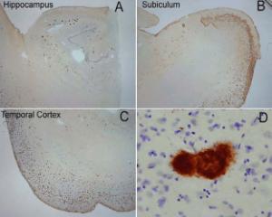 Immunohistochemistry analysis of human alzheimer