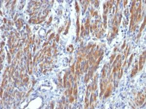 Immunohistochemical analysis of formalin-fixed, paraffin-embedded human leiomyosarcoma using Anti-MYH11 Antibody [SMMS-1]