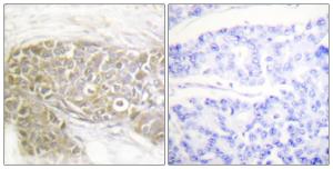 Immunohistochemical analysis of paraffin-embedded human breast carcinoma tissue using Anti-PEA-15 Antibody. The right hand panel represents a negative control, where the antibody was pre-incubated with the immunising peptide.