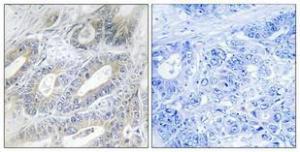 Immunohistochemical analysis of paraffin-embedded human colon cancer using Anti-NCLN Antibody 1:100 (4°C overnight). The right hand panel represents a negative control, where the antibody was pre-incubated with the immunising peptide