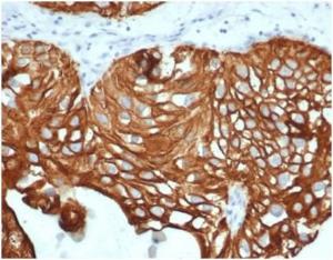 Immunohistochemical analysis of formalin-fixed, paraffin-embedded human bladder carcinoma tissue using Anti-Cytokeratin 7 Antibody [KRT7/4387R]