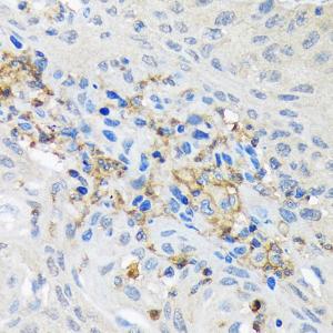 Immunohistochemistry analysis of paraffin-embedded human lung cancer using Anti-GNB2 Antibody [ARC1675] (A307743) at a dilution of 1:100 (40X lens). Perform microwave antigen retrieval with 10 mM Tris/EDTA buffer pH 9.0 before commencing with IHC staining protocol