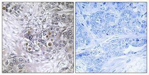 Immunohistochemical analysis of paraffin-embedded human breast cancer using Anti-ZNF147 Antibody 1:100 (4°C overnight). The right hand panel represents a negative control, where the antibody was pre-incubated with the immunising peptide