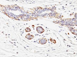 Immunohistochemical analysis of formalin-fixed, paraffin-embedded human breast carcinoma using Anti-MYH11 Antibody [MYH11/923]