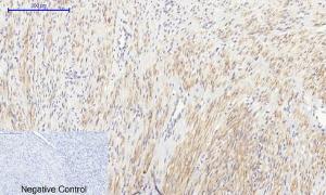 Immunohistochemical analysis of paraffin-embedded human uterus cancer tissue using Anti-IkappaB-alpha Antibody at 1:200 (4°C overnight). Negative control was secondary antibody only.