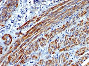 Immunohistochemical analysis of formalin-fixed, paraffin-embedded human leiomyosarcoma using Anti-MYH11 Antibody [MYH11/923]