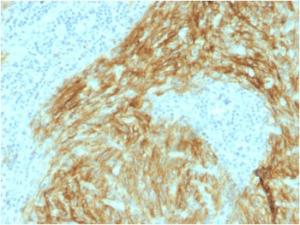 Immunohistochemical analysis of formalin-fixed, paraffin-embedded human follicular dendritic cell sarcoma using Anti-CD21 Antibody [CR2/1952]