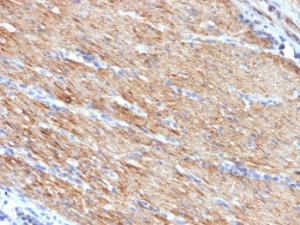 Immunohistochemical analysis of formalin-fixed, paraffin-embedded human colon carcinoma using Anti-MYH11 Antibody [MYH11/923]