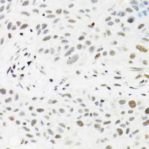 Immunohistochemistry analysis of paraffin-embedded human lung cancer using Anti-HTF9C/TRMT2A Antibody (A307746) at a dilution of 1:100 (40X lens). Perform microwave antigen retrieval with 10 mM PBS buffer pH 7.2 before commencing with IHC staining protocol