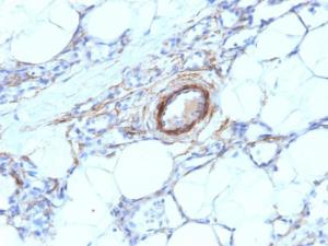 Immunohistochemical analysis of formalin-fixed, paraffin-embedded human angiosarcoma using Anti-MYH11 Antibody [MYH11/923]