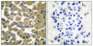 Immunohistochemical analysis of paraffin-embedded human breast carcinoma tissue using Anti-MMP-11 Antibody. The right hand panel represents a negative control, where the antibody was pre-incubated with the immunising peptide